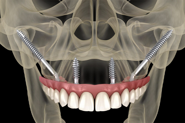 implants zygomatiques Turquie